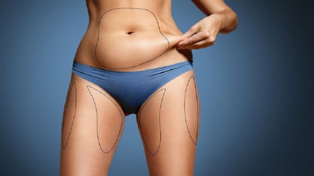 Liposuction fiyatları değişiyor mu Sürpriz Son