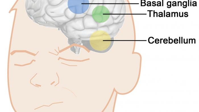 Beynin hesaplamalı modeli, Tourette'nin 'tiklerini' tetikleyen şeyleri gösterir